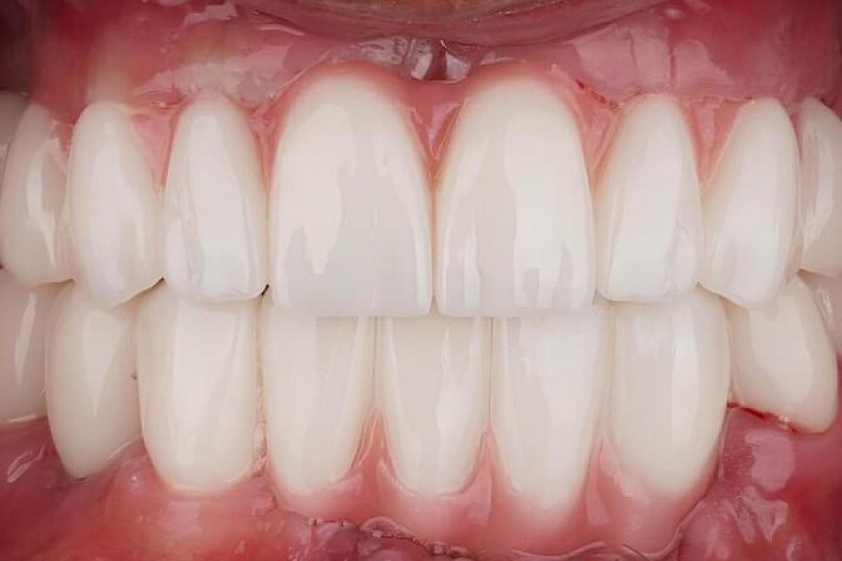 The Aussie Retiree Who Got His Smile Back