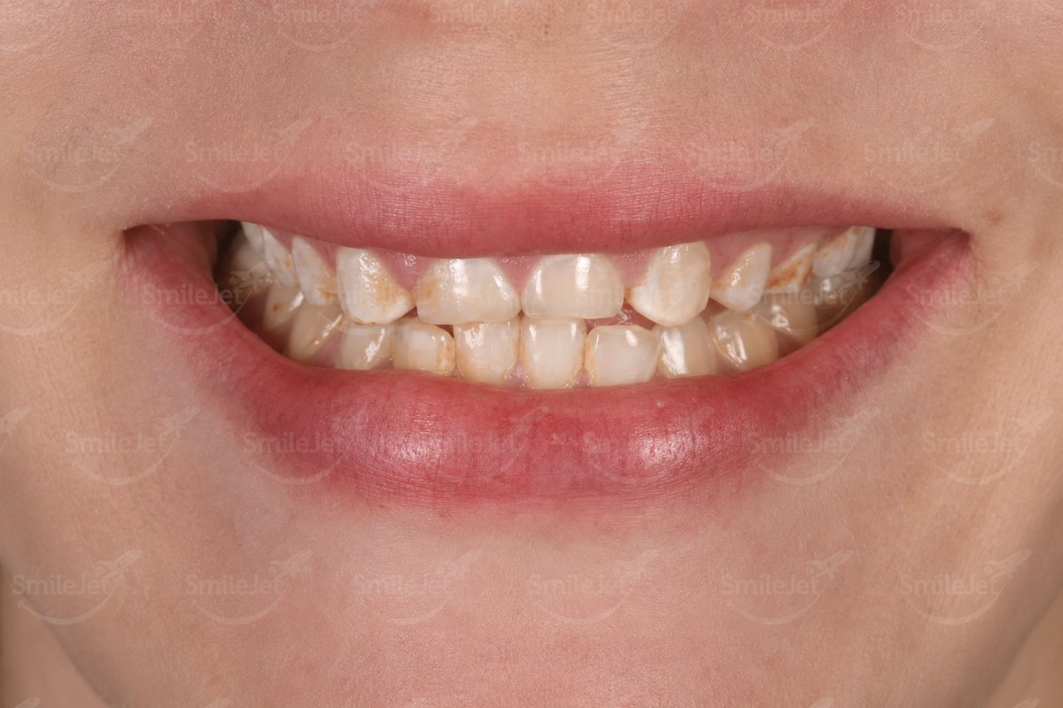 Before — Ms. Chen's Smile Makeover in Da Nang: 20 Veneers and Crowns for $8K vs $30K in Melbourne