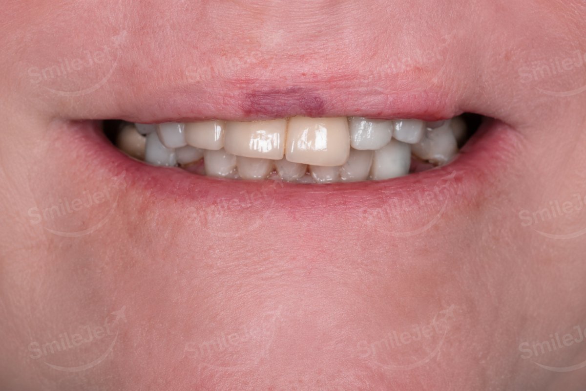 Before — Mr. Campbell's Smile Makeover in Hanoi: 23 Zirconia Crowns for $8K vs $27K+ in Perth