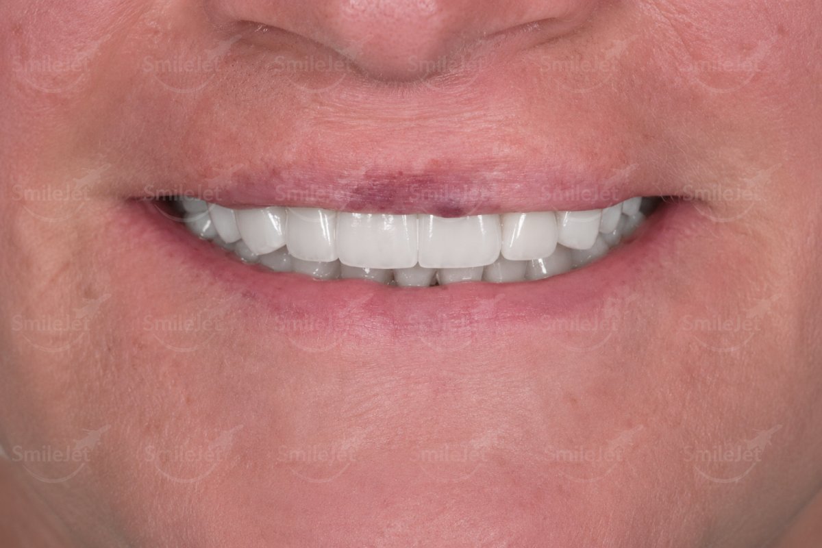 After — Mr. Campbell's Smile Makeover in Hanoi: 23 Zirconia Crowns for $8K vs $27K+ in Perth