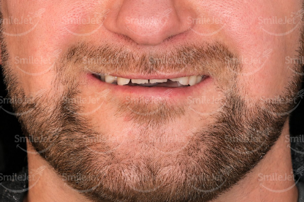 Before — Riley's Smile Makeover in Hanoi: 20 Crowns and Veneers for $7,000 vs $20,000 in Perth