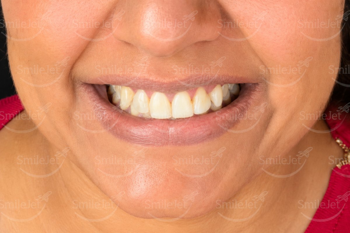 Before — Neha's Smile Makeover in Hanoi: 20 Veneers for $9K vs $26K in Sydney