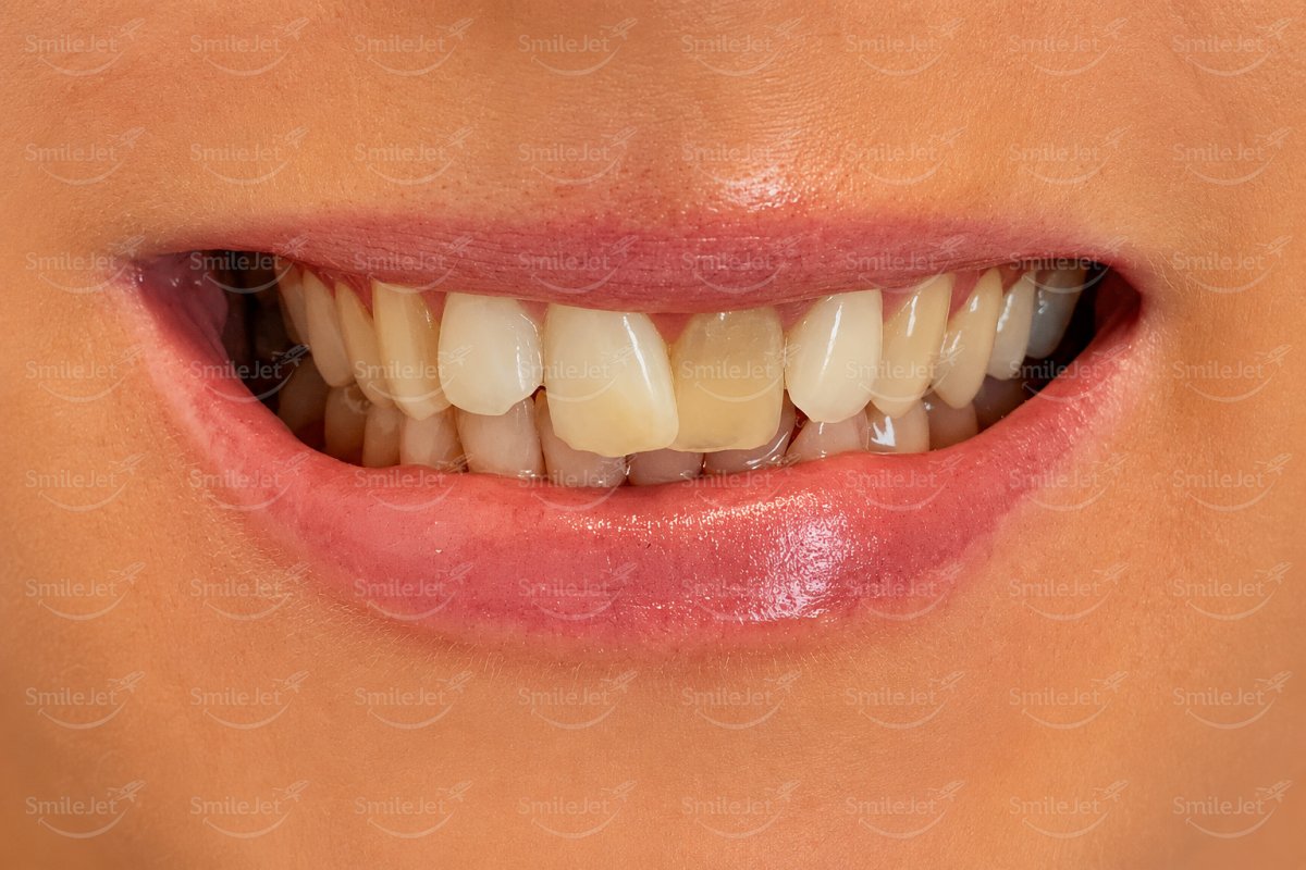 Before — Kavya's Smile Makeover in Da Nang: 22 Veneers for $8,360 vs $22K in Adelaide