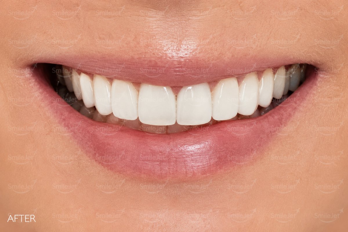 After — Kavya's Smile Makeover in Da Nang: 22 Veneers for $8,360 vs $22K in Adelaide
