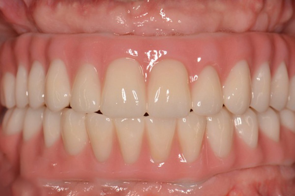 How Auckland gentleman saved NZ$36,760 with All on 6 Dental Implants in Vietnam