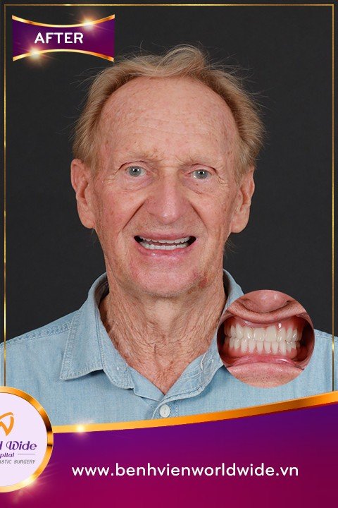 After: Full-Arch All-on-6 Implants at Worldwide Hospital, Ho Chi Minh City