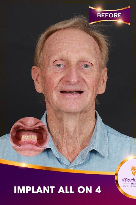 Before: Full-Arch All-on-6 Implants at Worldwide Hospital, Ho Chi Minh City