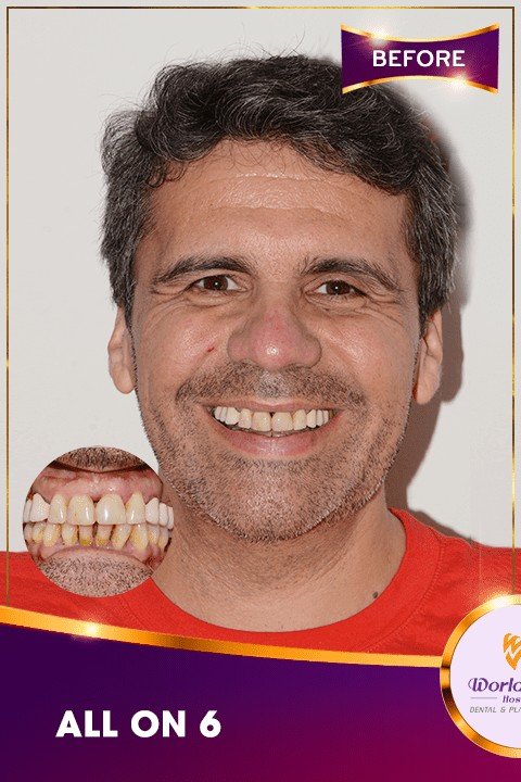 Before — All-on-4 Full-Arch Implants at Worldwide Hospital, Ho Chi Minh City