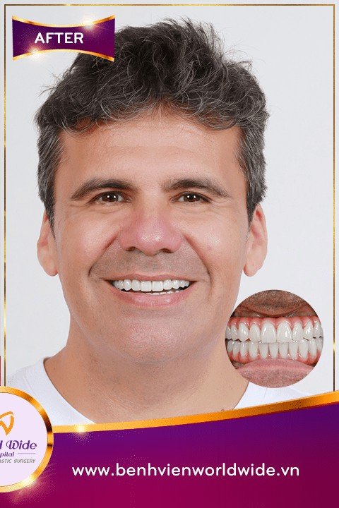After — All-on-4 Full-Arch Implants at Worldwide Hospital, Ho Chi Minh City