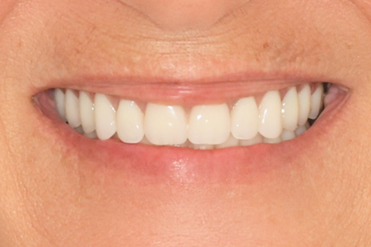 All-on-4 in Vietnam: A Scottsdale Retiree's Full-Mouth Implant Story