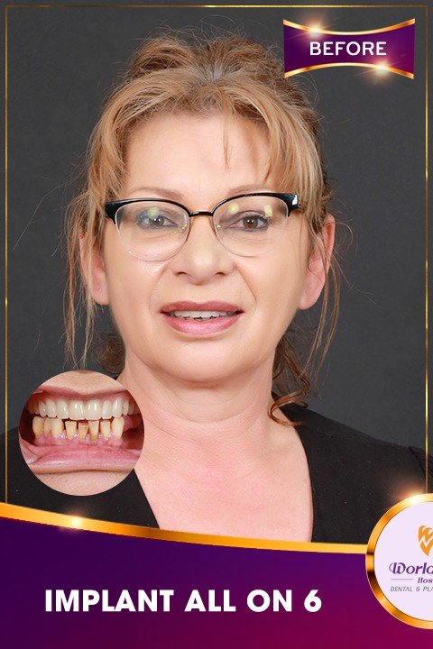 Before — All-on-4 Smile Restoration for a US Patient at Worldwide Hospital