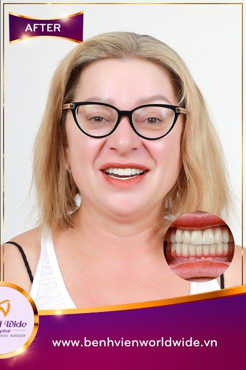 After — All-on-4 Smile Restoration for a US Patient at Worldwide Hospital