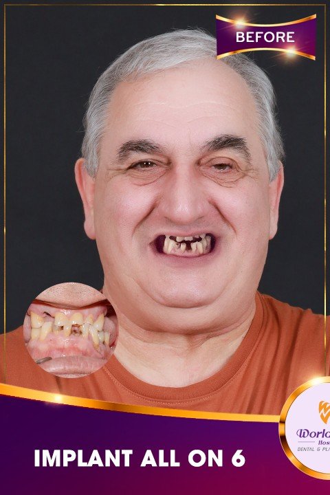 Before — All-on-6 Full-Arch Implants at Worldwide Hospital for an Italian Patient