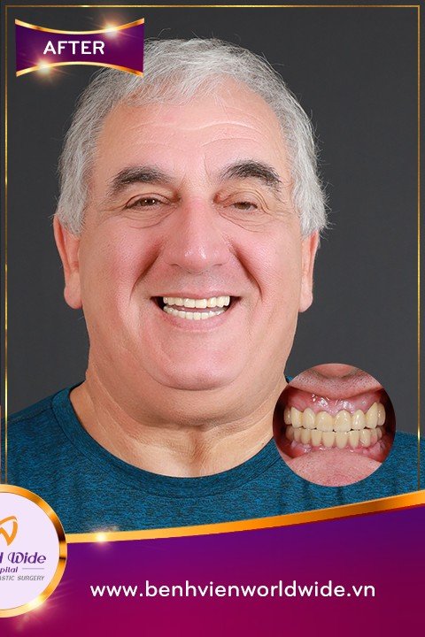 After — All-on-6 Full-Arch Implants at Worldwide Hospital for an Italian Patient
