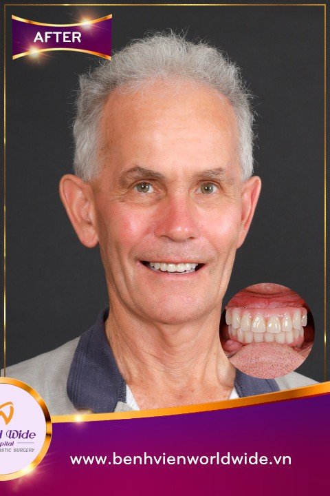 After — All-on-4 Implant Treatment at Worldwide Hospital for a UK Patient