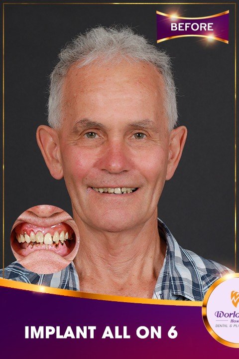 Before — All-on-4 Implant Treatment at Worldwide Hospital for a UK Patient