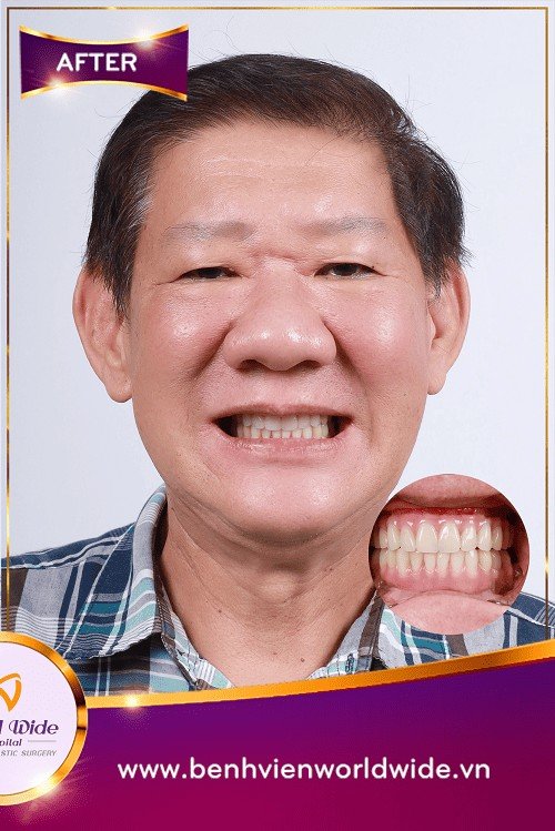 After — Full-Arch Zygoma Implant Reconstruction at Worldwide Hospital, Ho Chi Minh City