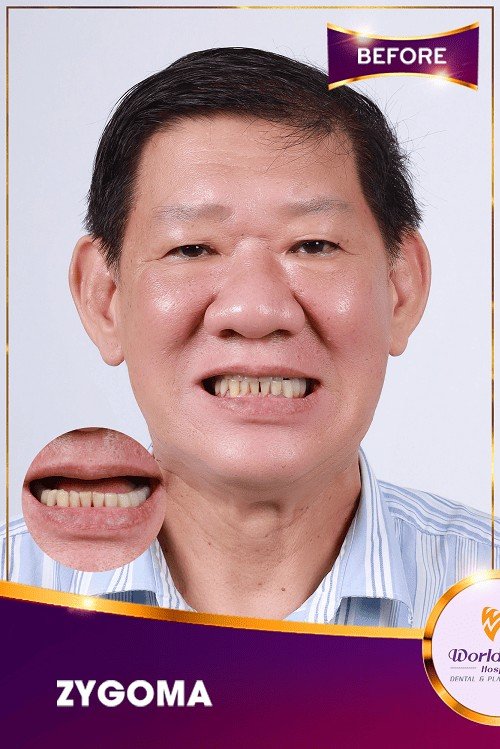 Before — Full-Arch Zygoma Implant Reconstruction at Worldwide Hospital, Ho Chi Minh City