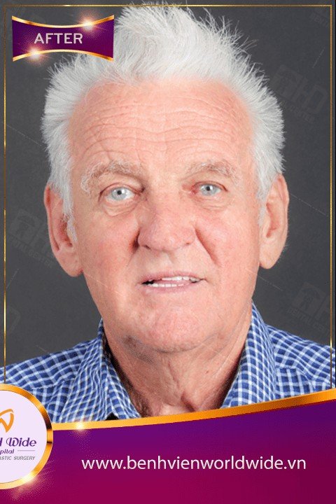 After — All-on-4 Full-Arch Restoration at Worldwide Hospital for an Australian Patient