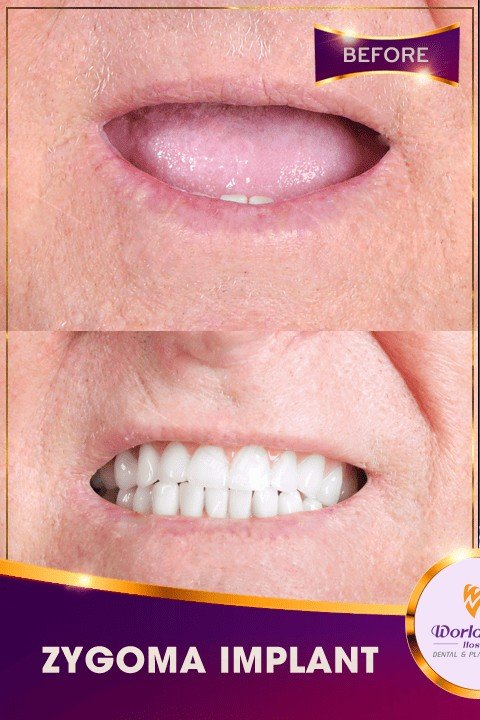Before — All-on-4 Full-Arch Restoration at Worldwide Hospital for an Australian Patient