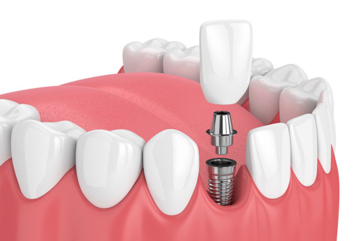 Dental Implant in Vietnam