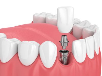 Dental Implant