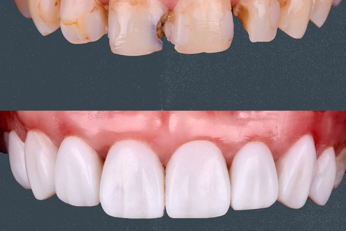 Composite Veneer (direct bonding) in Vietnam