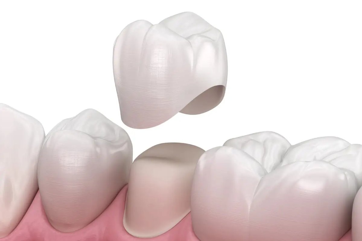 Full Porcelain/Ceramic Crown