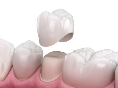 Full Porcelain/Ceramic Crown