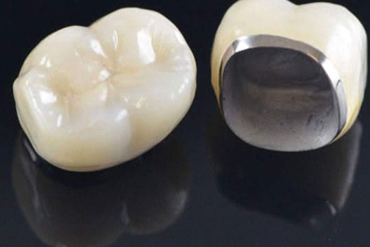 Porcelain Fused to Metal Crown (standard alloy)