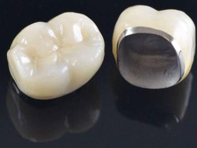 Porcelain Fused to Metal Crown (standard alloy)