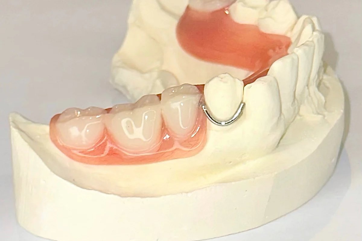 Partial Denture, Acrylic Frame