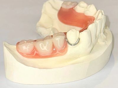Partial Denture, Acrylic Frame