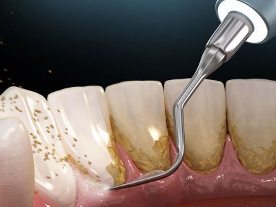 Deep Cleaning, Scaling & Root Planing