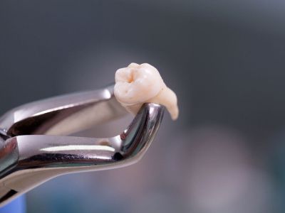 Wisdom Tooth Extraction