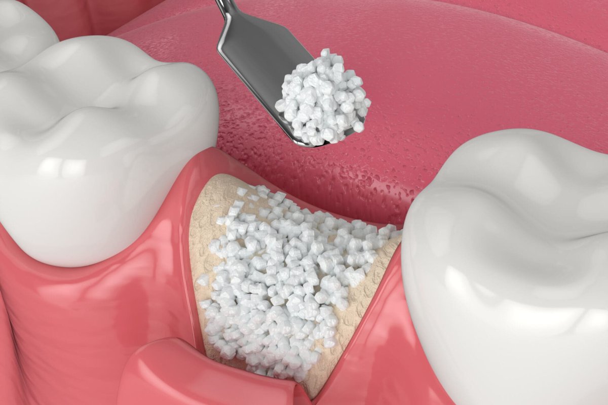 Bone grafting in Vietnam