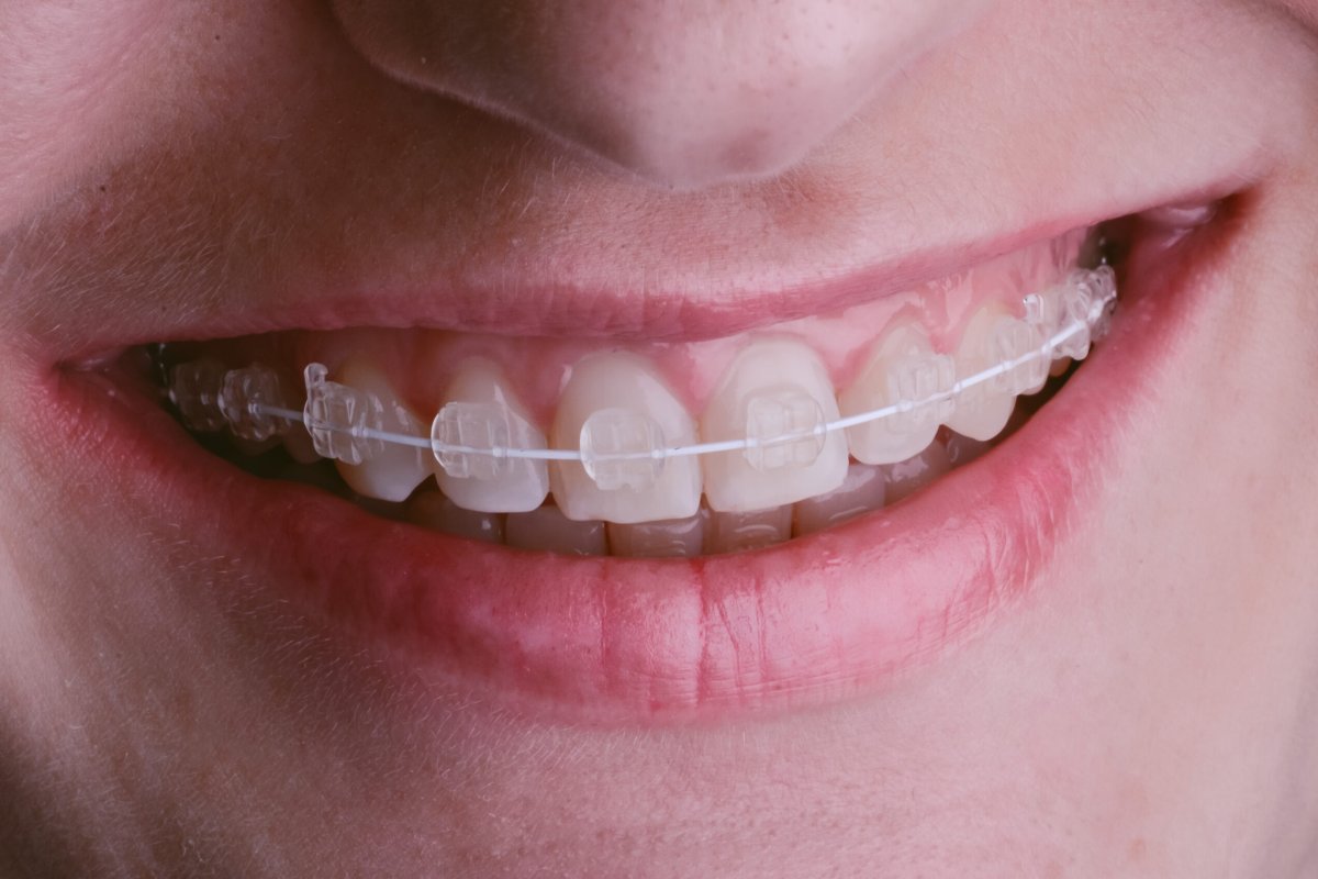 Clear Braces in Vietnam