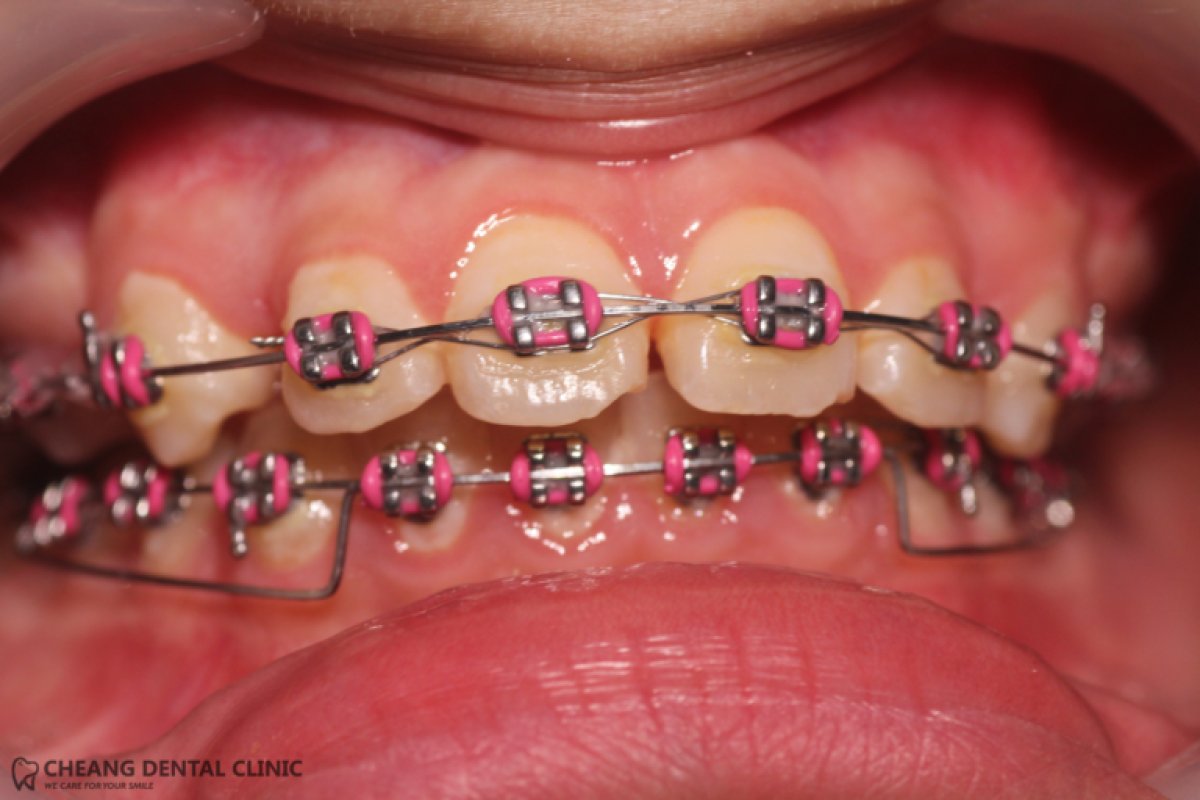 Conventional Braces in Vietnam