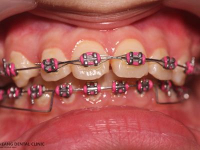Conventional Braces