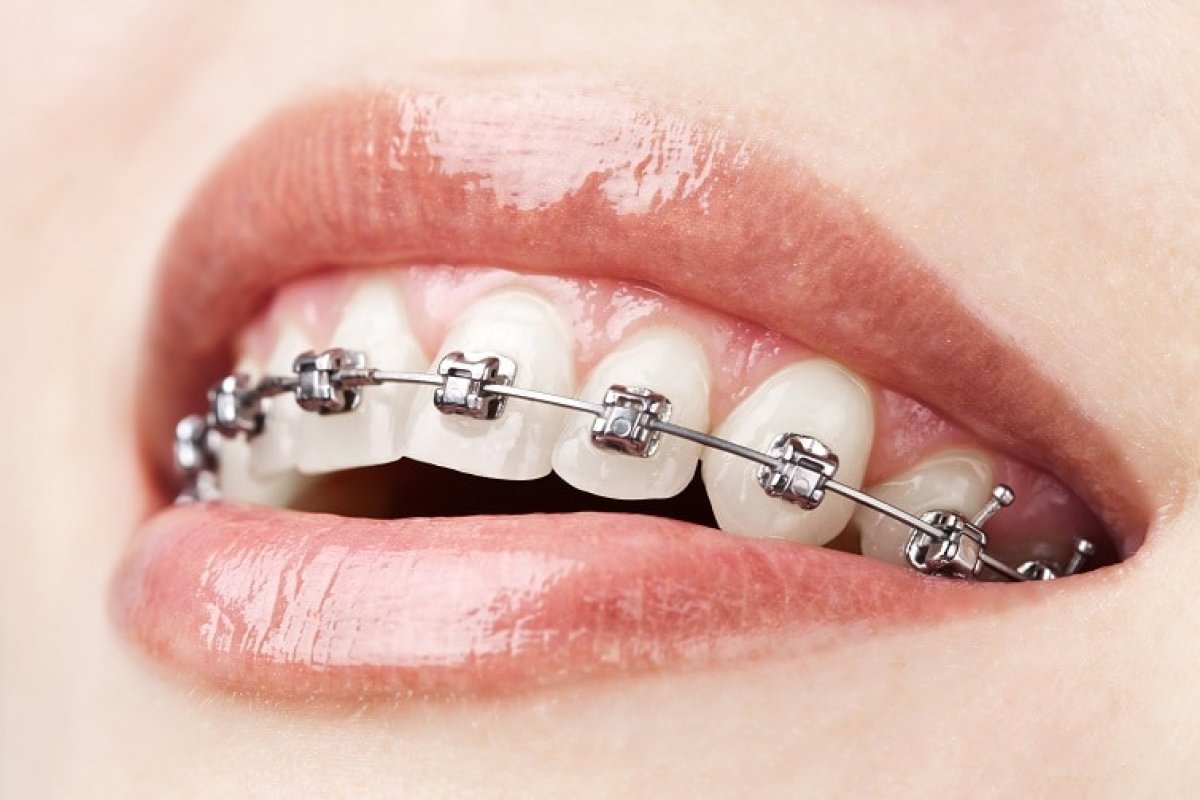 Damon Braces in Vietnam