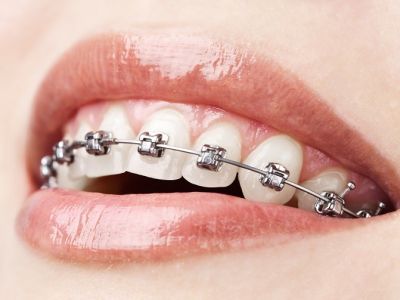 Damon Braces