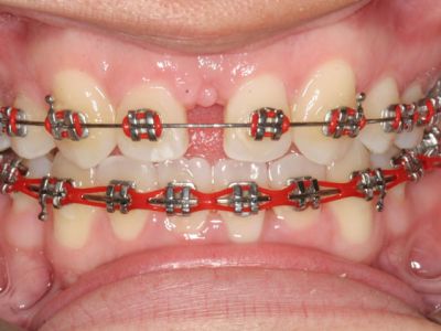 Metal Braces