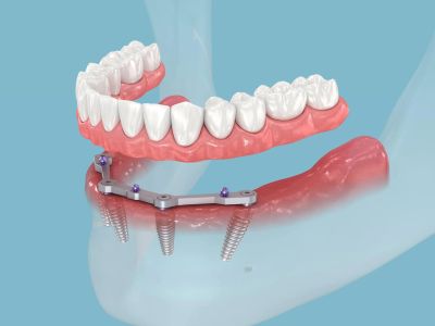 All on 4 Dental Implants