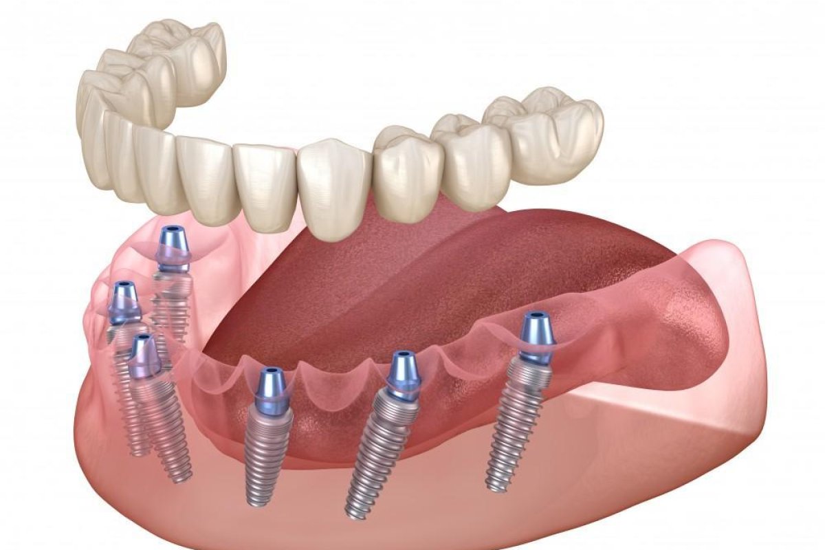 All on 6 Dental Implants in Vietnam