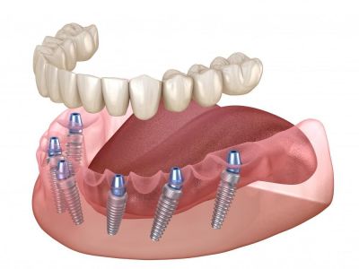 All on 6 Dental Implants