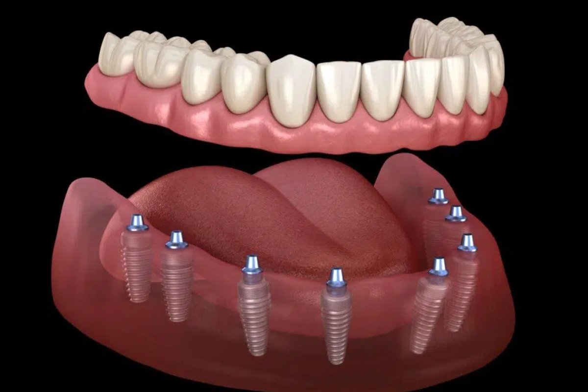 All on 8 Dental Implants in Vietnam