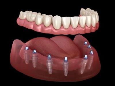 All on 8 Dental Implants