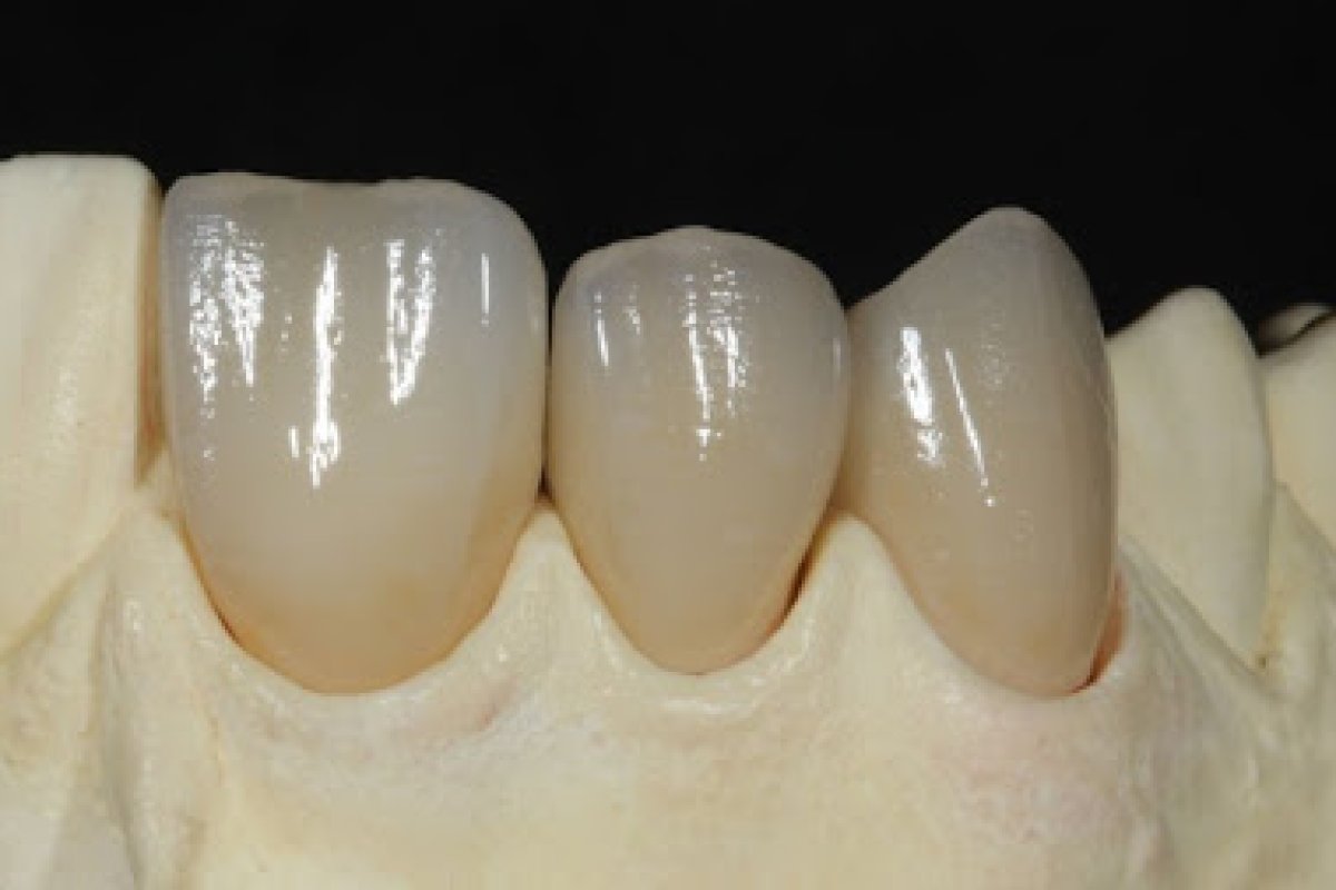 E-max Crown (Lithium Disilicate)