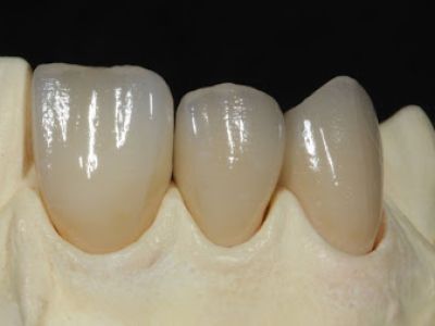 E-max Crown (Lithium Disilicate)