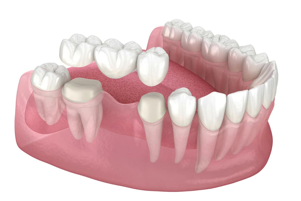 Dental Bridges in Vietnam